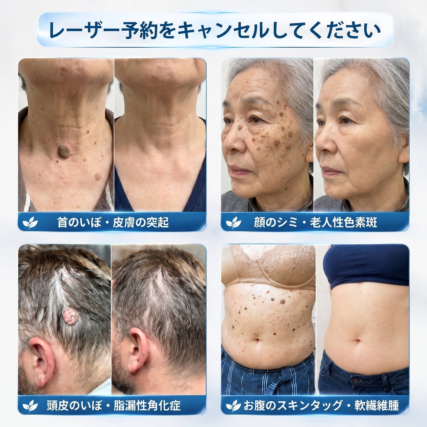 公式ショップ🧴🎈𝐏i𝐜𝐝o® 7日間 シミ取り 傷跡ケア ペン(痛みゼロ、傷ゼロのローラーボール)💪