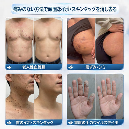 公式ショップ🧴🎈𝐏i𝐜𝐝o® 7日間 シミ取り 傷跡ケア ペン(痛みゼロ、傷ゼロのローラーボール)💪